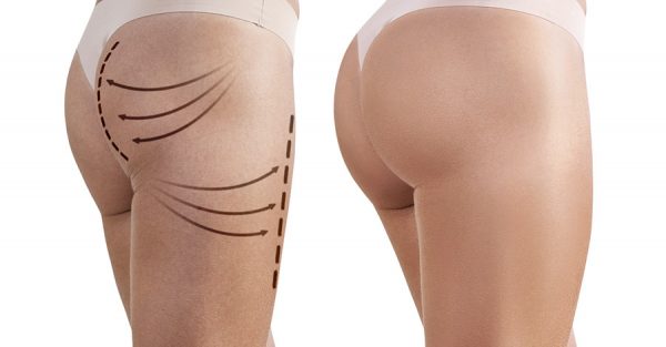 gluteoplastica-risultati-intervento-rimodellare-glutei-e1550767730135.jpg