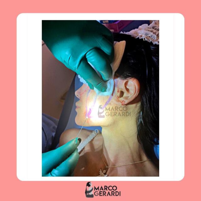 ‼️Oggi parliamo di fili di trazione.

Come si intuisce dal nome, posizionati in punti strategici del volto, hanno il compito di trazionare i tessuti ridisegnando i contorni del volto.
Favoriscono l’incremento di fibroblasti, collagene, fibre elastiche e della matrice cellulare di Acido Ialuronico, migliorano la vascolarizzazione e sono totalmente riassorbibili in massimo 18 mesi.

Lo studio medico Marco Gerardi resta sempre a vostra disposizione per dubbi o chiarimenti🌼

Per consulti, prime visite, domande o informazioni:
📲 chiama o invia un whatsapp al numero (+39) 3911591335
📧 invia una email a
dottmarcogerardi@gmail.com

#studiomedicogerardi #marcogerardi #chirurgiaplastica #chirurgiaestetica #interventochirurgico #medicochirurgoroma #chirurgiaplasticaroma #filiditrazione #ringiovanimentoviso
