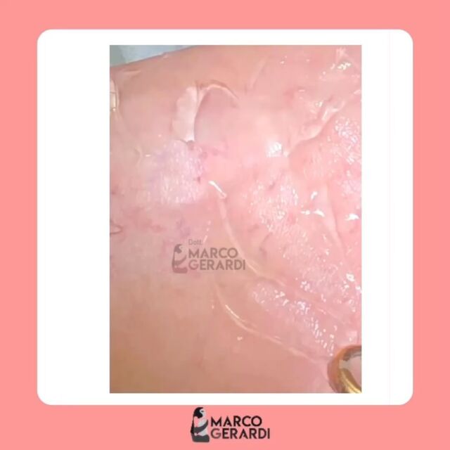 Care amiche e amici dello studio medico Marco Gerardi bentrovati! 
Oggi voglio presentarvi il laser NdYag laser 1064 Nm: lavora con una lunghezza d’onda come gli infrarossi e si rivela particolarmente utile per contrastare e far scomparire i capillari, le piccole vene( teleangiectasie) e le piccole varicosità degli arti inferiori. Se abbinato al trattamento con farmaci sclerosanti e schiume istruttive risolve permanentemente queste problematiche.

Lo studio medico Marco Gerardi resta sempre a vostra disposizione per dubbi o chiarimenti🌼

Per consulti, prime visite, domande o informazioni:
📲 chiama o invia un whatsapp al numero (+39) 3911591335
📧 invia una email a
dottmarcogerardi@gmail.com

#studiomedicogerardi #marcogerardi #chirurgiaplastica #chirurgiaestetica #venevaricose #laser #interventochirurgico #medicochirurgoroma #chirurgiaplasticaroma