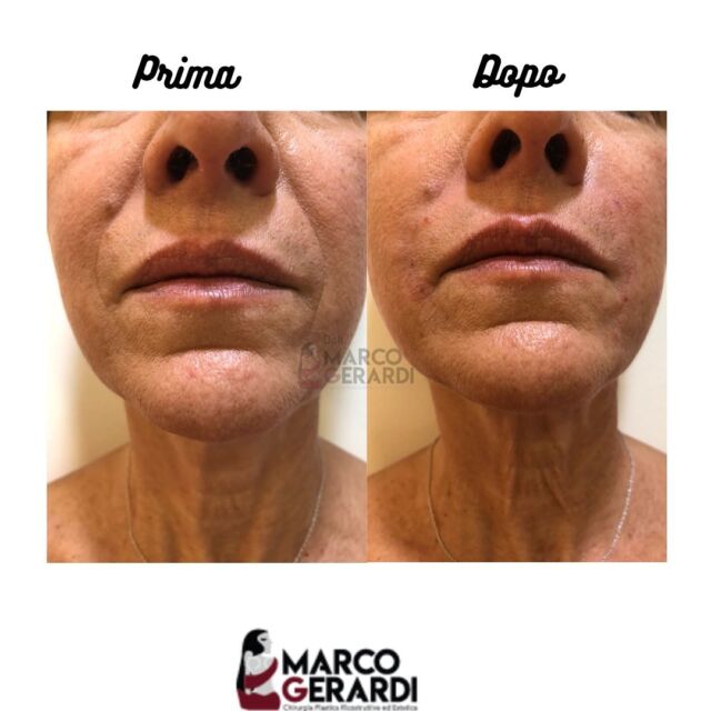 Care amiche e amici dello studio medico Marco Gerardi bentrovati! 

Parliamo ancora di uno dei trattamenti più richiesti: i filler a base di acido ialuronico.
In questo caso abbiamo trattato i solchi genio labiali.
È un tipo di trattamento non invasivo che permette di attenuare, modificare o far scomparire le rughe. L’effetto è immediato e non richiede solitamente l’applicazione di un anestetico pre trattamento. 
La durata è di 5/6 mesi trattandosi di materiale di origine sintetica a DNA ricombinante.

Lo studio medico Marco Gerardi resta sempre a vostra disposizione per dubbi o chiarimenti🌼

Per consulti, prime visite, domande o informazioni:
📲 chiama o invia un whatsapp al numero (+39) 3911591335
📧 invia una email a
dottmarcogerardi@gmail.com

#studiomedicogerardi #marcogerardi #chirurgiaplastica #chirurgiaestetica #filleracidoialuronico #filler #interventochirurgico #medicochirurgoroma #chirurgiaplasticaroma