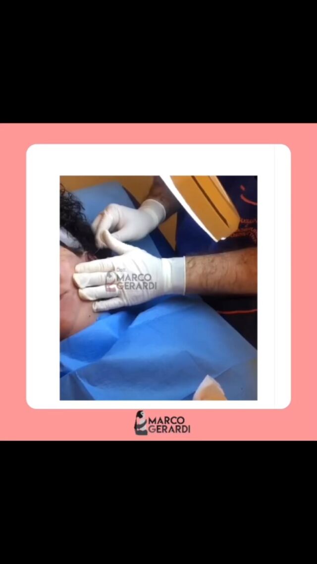 ⛔️Contenuti sensibili

Care amiche e amici dello studio medico Marco Gerardi bentrovati!
 
Oggi parliamo di #filidisospensione : una tecnica di minilifting non invasiva, utile per ringiovanire il volto, contrastare le rughe sottili e i cedimenti cutanei. 

Lo studio medico Marco Gerardi resta sempre a vostra disposizione per dubbi o chiarimenti🌼

Per consulti, prime visite, domande o informazioni:
📲 chiama o invia un whatsapp al numero (+39) 3911591335
📧 invia una email a
dottmarcogerardi@gmail.com

#studiomedicogerardi #marcogerardi #chirurgiaplastica #chirurgiaestetica #filidisospensione #filler #interventochirurgico #medicochirurgoroma #chirurgiaplasticaroma
